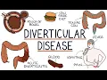 Understanding Diverticulosis and Diverticulitis