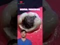 Download Lagu Dental Filling Explained !?