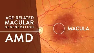 Download Age Related Macular Degeneration | Anti - VEGF ||  ARMD- Patient Education \u0026 Explanation MP3