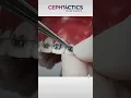How to place modules or elastic ligatures on fixed braces