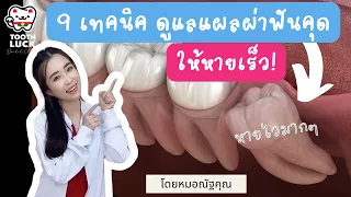  ทำไมต้องหลีกเลี่ยงการอมหรือดูดแผลหลังผ่าฟันคุด 