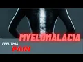 What To Know About Myelomalacia no background music