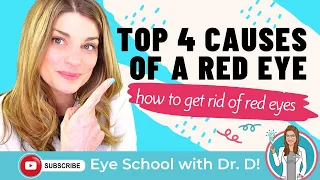 Download How To Get Rid Of Red Eyes | Top 4 Causes Of A Red Eye | An Optometrist Dishes all the Dirt! MP3