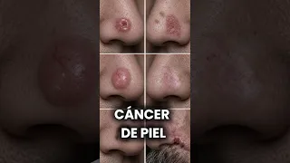 El cáncer más común del cuerpo humano puede verse de todas estas formas. #dermatologia #dermatologo
