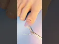 Download Lagu How Toenail Removal Works 😳