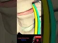 Download Lagu Sciatic nerve pain - Sciatica pathophysiology, causes and treatment