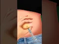 Download Lagu how to inject insulin in belly fat #3danimation #shortsvideo #doctor
