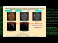 Python Code for Diabetic Retinopathy Detection Using CNN Python OpenCV Project
