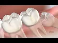 Wisdom Teeth Removal in Tucson AZ Arizona Oral Maxillofacial Surgeons
