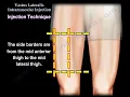 Vastus Lateralis Intramuscular Injection Safe and Effective Technique