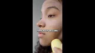 Conquer Hormonal Acne The Power of Spironolactone