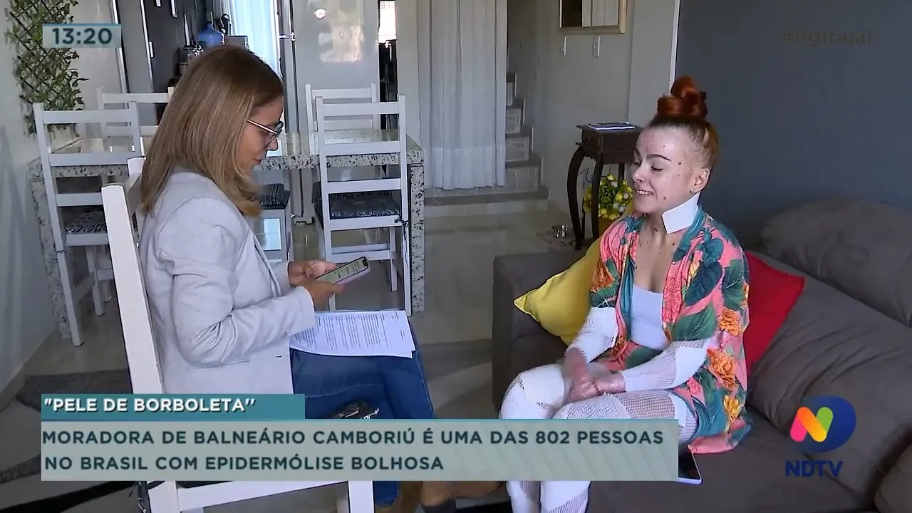 "Pele de Borboleta" Moradora de Balneário Camboriú é uma das 802 pessoas no Brasil com a doença