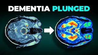 Dementia Rates PLUNGED In Study Of 1 Million People 