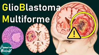GBM Explained | Glioblastoma Pathology, Necrosis & Microvascular Proliferation