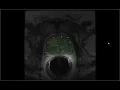 PCG-Cut Graph Driven Segmentation of the Prostate Central Gland