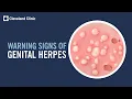 Download Lagu 5 Warning Signs of Genital Herpes