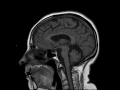 Multisystem Atrophy