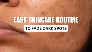 EASY SKINCARE ROUTINE TO FADE DARK SPOTS AND ACNE MARKS