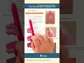 Understanding Burn Injuries for Nursing Students