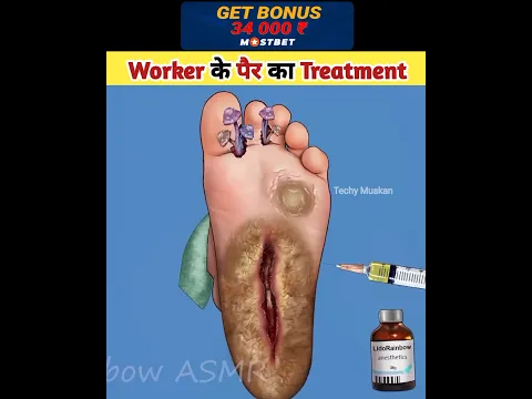 Worker के पैर का Treatment #asmr #shortsvideo