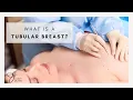 Understanding Tubular Breasts Adolescent Breast Deformities