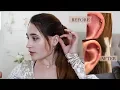 How I Treated My Hypertrophic Scar on Helix Piercing with photos