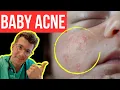 Doctor explains BABY ACNE aka NEONATAL ACNE Symptoms photos treatment more