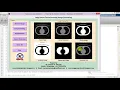 Matlab Code for Lung Cancer Detection Using Image Processing