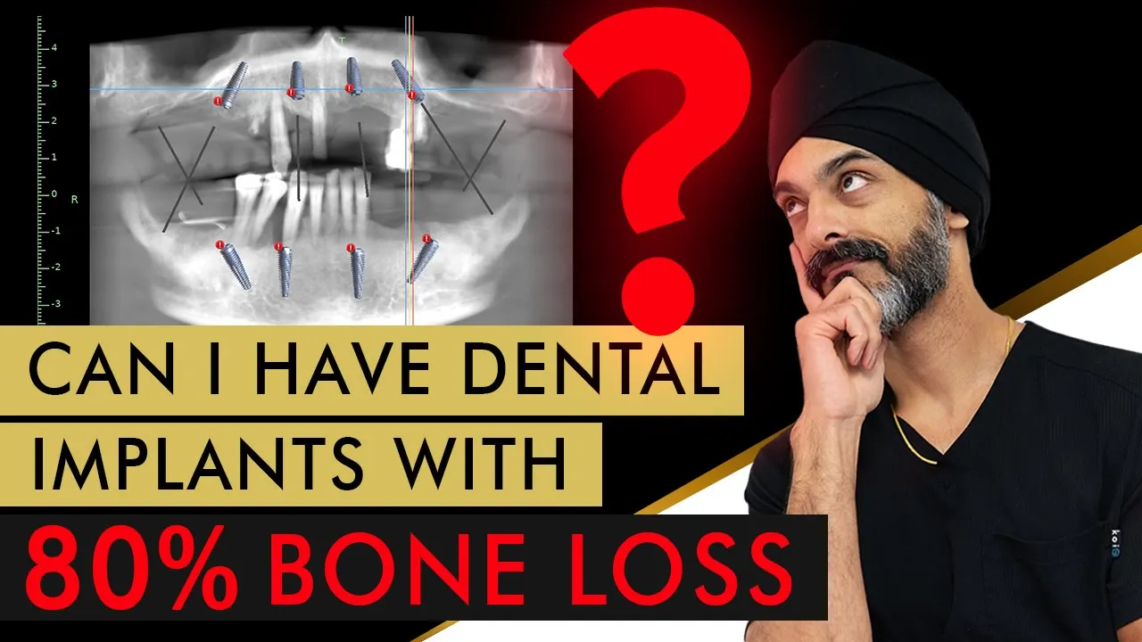 Outline Video Can you have Dental Implants with 80% Bone Loss