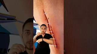 طريقة فك الغرز الطبية 