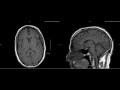Unremarkable Non-Contrast Brain MRI Sagittal T1-Example 1