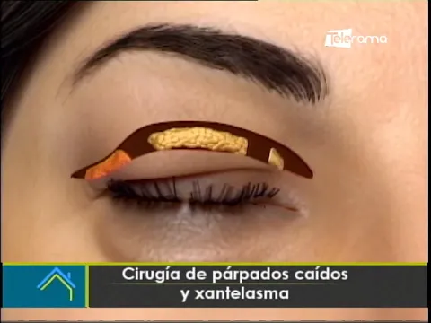 Estética al Día: Cirugía de párpados caídos y xantelasma