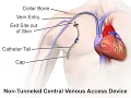 Central venous catheter CPT code - simplify medical coding