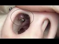how to get rid of nose piercing bump inside your nose tutorial