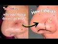 Nose Piercing Bump Removal in right way