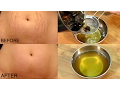 Get Rid Of Stretch Marks In 30 Days Stretch Marks Removal Simple Beauty Secrets
