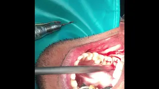 Download Dis Impaction - Wisdom tooth or third molar extraction MP3