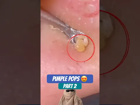 Extreme Pimple Pops | Part 2 π #pimples #oddlysatisfying #skincare #pimplepopping #reaction