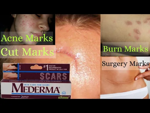 Download MP3 Mederma Cream Review And Uses In Hindi | How to Remove Surgery Scars, Burn Scars, Cut Marks, Acne