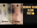 Download Lagu Remove scars from face - Start a new journey with Dr. Anvika