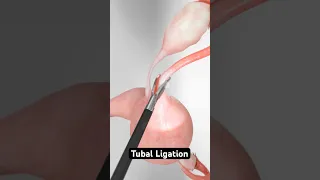 Three methods for permanent female sterilization 3D Animation