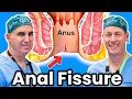 Download Lagu How To Get Rid Of Anal Fissures