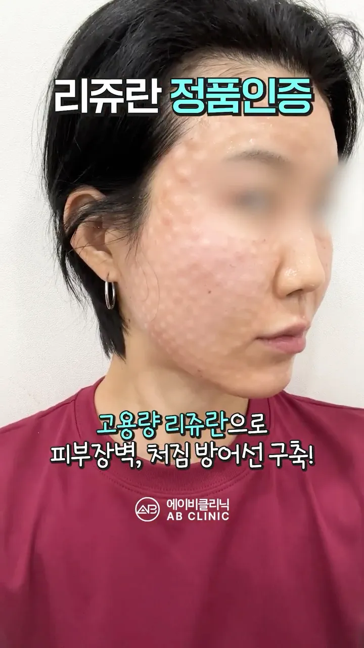 고용량 리쥬란 엠보!
