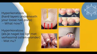 RELEAF RECOVERY for Hardened Skin Cells between the Nail Plate the Nail Bed