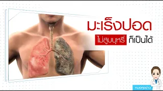  การรักษาโรคมะเร็งปอดขึ้นอยู่กับอะไร และมีวิธีการรักษาแบบไหนบ้าง 