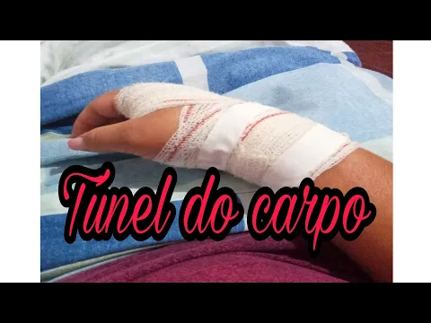 Download MP3 FIZ CIRURGIA DO TÚNEL DO CARPO.LIVRE DE DORMÊNCIA E FORMIGAMENTO . PRIMEIRA CIRURGIA Bilateral.