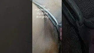 Hymenoplasty Re Virgin Re Seal First Night Bleeding First Time Sex Safe Hymen Repair  Hymenoplasty Re Virgin Re Seal First Night Bleeding First Time Sex Safe Hymen Repair