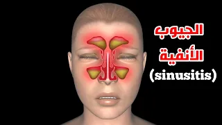 ماهو التهاب الجيوب الأنفية  وكيف يتم علاجها                             دندنها
