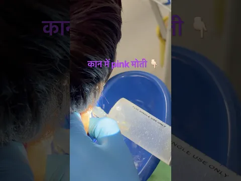 कान में pink मोती। Doctor removed .