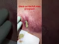 Large Double Wide Abscess. See full video - https://youtu.be/E6tX-3t1-QE?si=-wX831ckhRxvBd4O